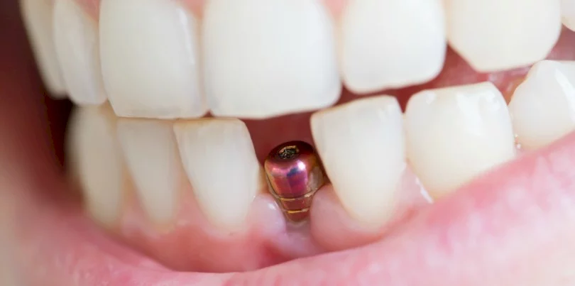 Quando um paciente com periodontite pode colocar implantes?