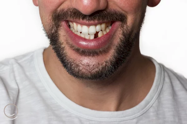 Quais os problemas que a perda de um dente pode causar?