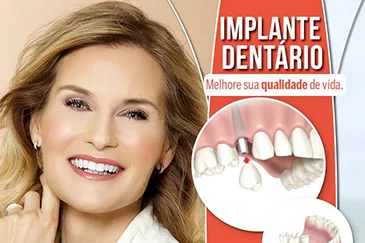 Implantes dentários: renove seu sorriso