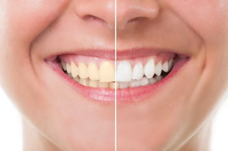 Clareamento Dental: indicativo de saúde bucal e dentes mais brancos