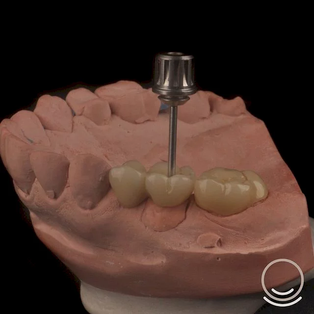 Qual é o tempo de cicatrização do implante dentário?