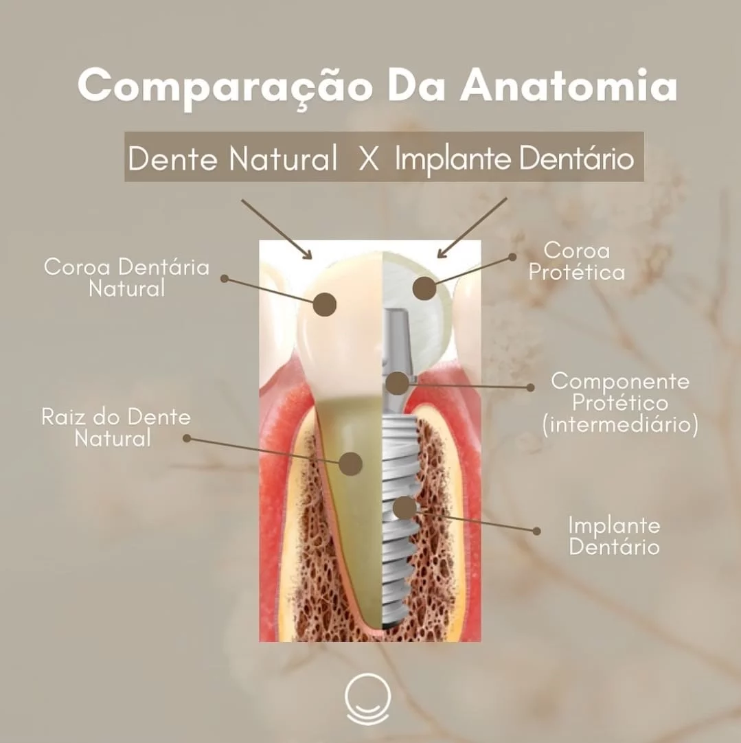 Quais diferenças entre implante dentário e um dente natural?